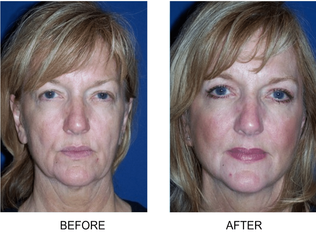 Case 16 One Hour SMART Facelift Best Cosmetic Surgeons